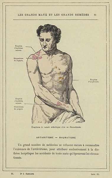 Eruptions de nature arthritique chez un rhumatisant (colour litho)