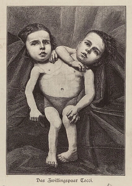 Giacomo and Giovanni Battista Tocci, Italian conjoined twins (engraving)