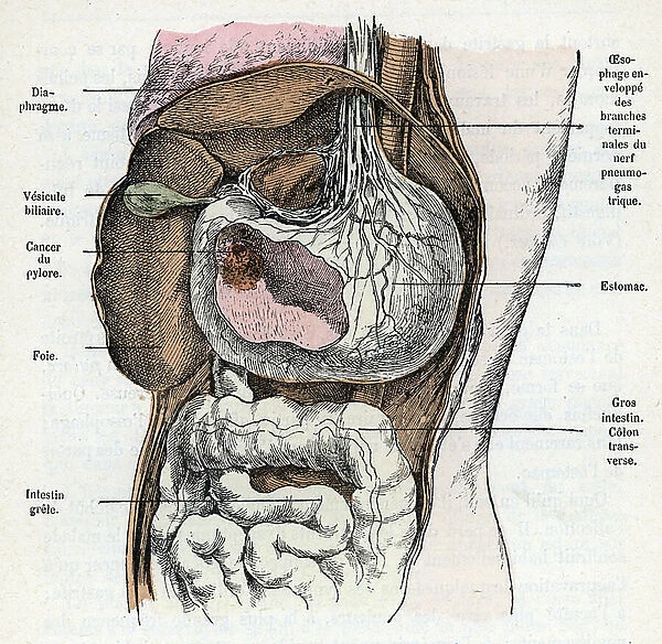 Stomach cancer Engraving from 'Nature and Man' by Rengade 1881 Private collection