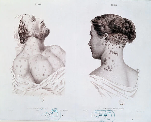 Symptoms of syphilis in men and women, from a medical book, c