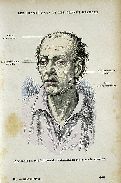 Symptons characteristic of long-term mercury poisoning. From Jules Rengade Les Grands Maux et les Grands Remedes, Paris, c1890