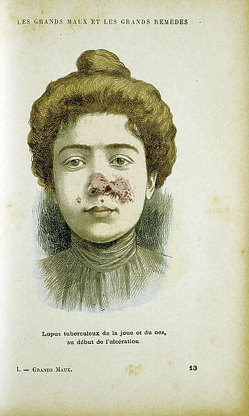 Woman suffering from Lupus Vulgaris, a tubercular skin infection. From Jules Rengade Les Grands Maux et les Grands Remedes, Paris, c1890. Formerly a disfiguring disease, it responds well to modern drugs for tuberculosis and is now rare