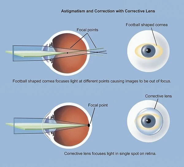 Astigmatism and correction with corrective lens