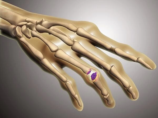 Conceptual image of rheumatoid arthritis in the human hand