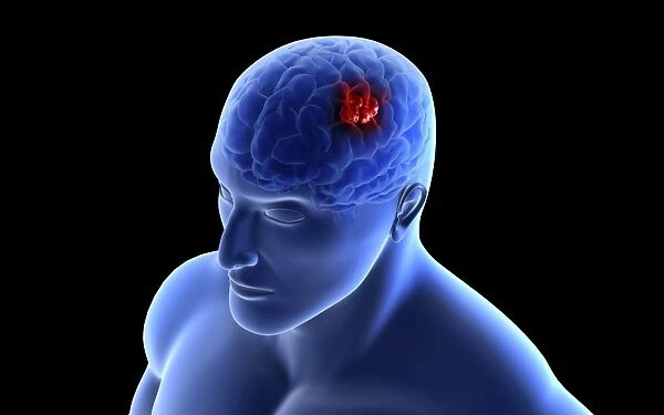 Conceptual image of a tumor in human brain