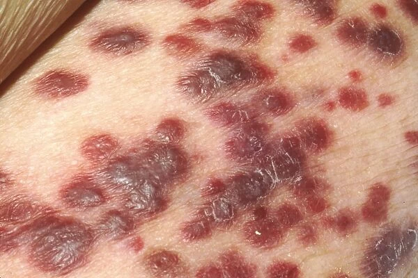 Kaposis sarcoma on the skin of an AIDS patient