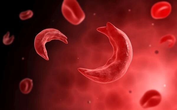 Microscopic view of sicke cells causing anemia disease