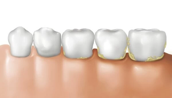 Row of teeth showing gingivitis