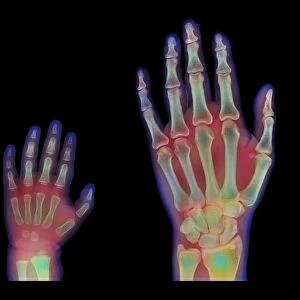 Adult and child hand X-rays