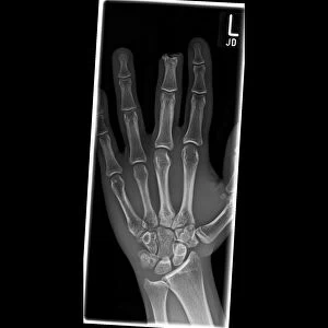 Amputated finger, X-ray C017 / 8010