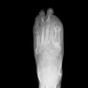 Amputated toes, X-ray C017 / 7166