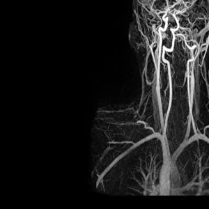 Artery damage, MRA scan