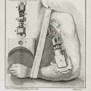 Bone-setting mechanism, 18th century