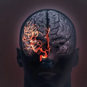 Brain aneurysm, 3D scan