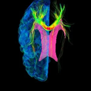Brain fibres, DTI MRI scan C017 / 7038