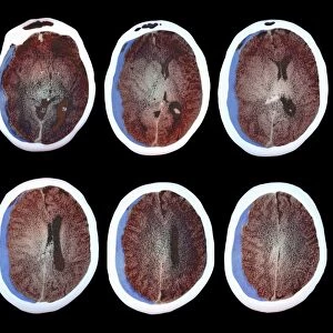 Brain haemorrhage, CT scans C018 / 0569