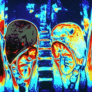 Colour MRI scan of abdomen showing kidneys & liver