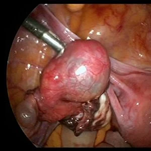 Ectopic pregnancy, endoscope view C017 / 6804