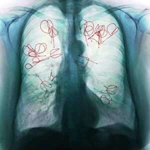 Endobronchial valves, X-ray F008 / 3470