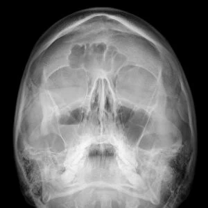 Facial fractures, X-ray C017 / 7638