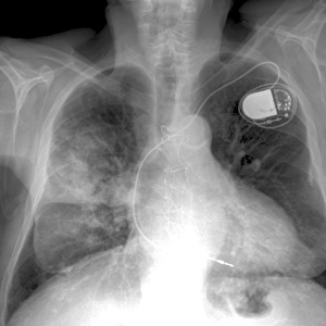 Heart and lung disease, X-ray C018 / 0498