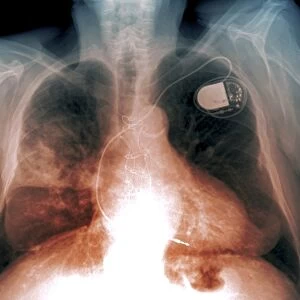 Heart and lung disease, X-ray C018 / 0500