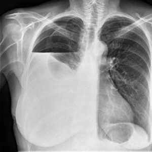 Hydropneumothorax, X-ray C017 / 7810
