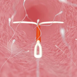 IUD contraceptive and sperm cells