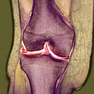 Knee meniscus tear