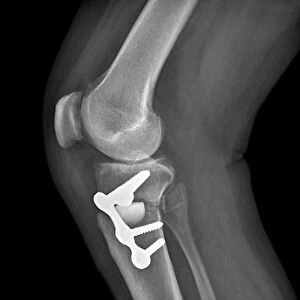 Knee realignment surgery, X-ray C016 / 6602