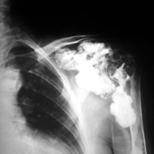 Melorheostosis of the shoulder, X-ray