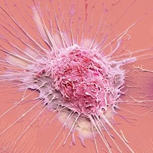 Mouth cancer cell, SEM