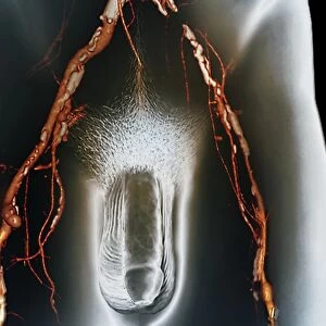 Narrowed arteries, 3D CT scan F006 / 9113