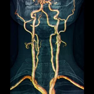 Neck arteries to the brain, 3D MRI scan