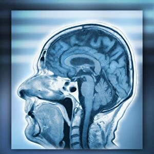 Normal head and brain, MRI scan
