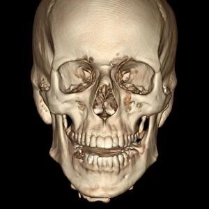 Normal skull, 3D CT scan