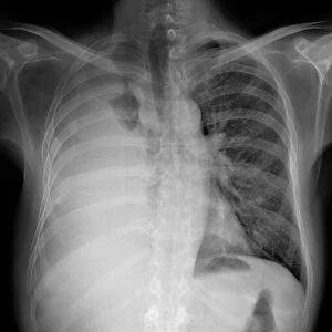 Pleural effusion, X-ray C017 / 7753