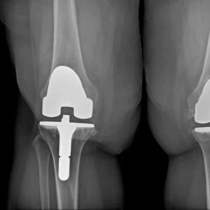 Prosthetic knees and obesity, X-ray C016 / 6596