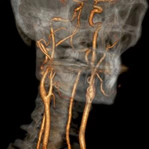 Stenosis of carotid artery, CT scan