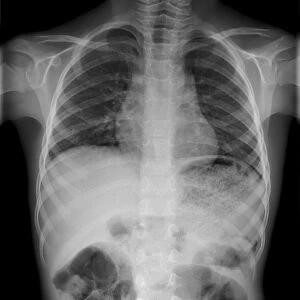 Swallowed marble, X-ray C017 / 7749