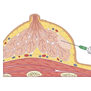 Cross section biomedical illustration of fine needle aspiration of breast lump