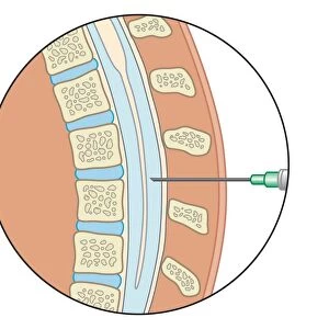 Digital illustration of lumbar puncture using spinal needle inserted into lumbar vertebrae and dura mater