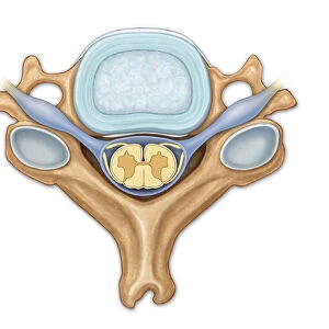 Normal axial view of C5 showing disk, nerve roots, posterior