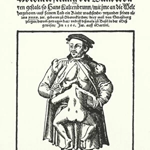 Hans Kaltenbrunn and his undeveloped conjoined twin (engraving)
