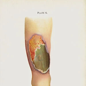 Ulcerating hospital gangrene (colour litho)