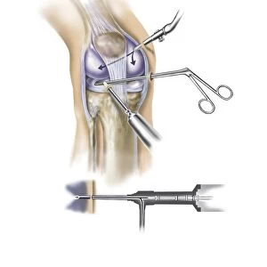 Detail of human knee showing insertion of arthroscopic instruments
