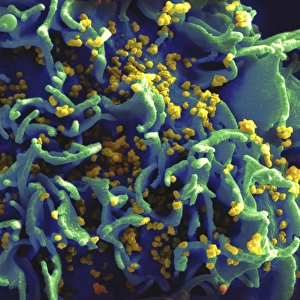 Scanning electron micrograph of HIV particles infecting a human T cell